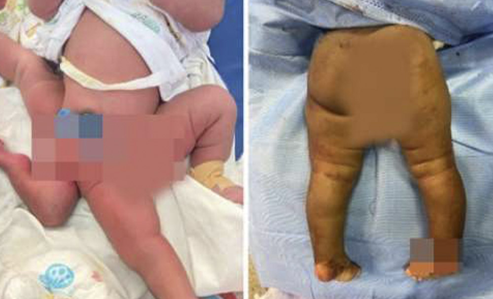 KATH doctors conduct 6-hour successful surgery on 5-month-old baby born with 4 legs