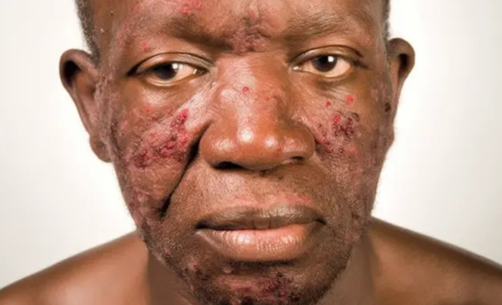 When a rash told a deeper story: How a woman battled a rare eye condition linked to shingles and HIV